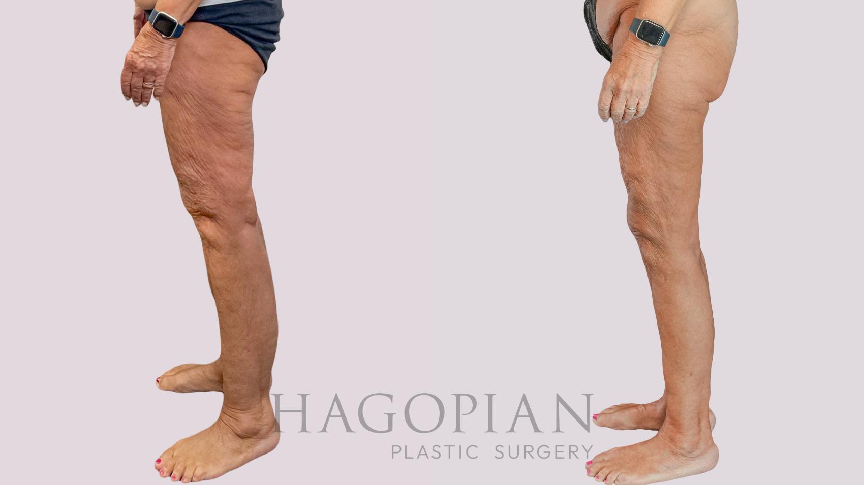 Before & After Thigh Lift Case 261 Left Side View in Atlanta, GA