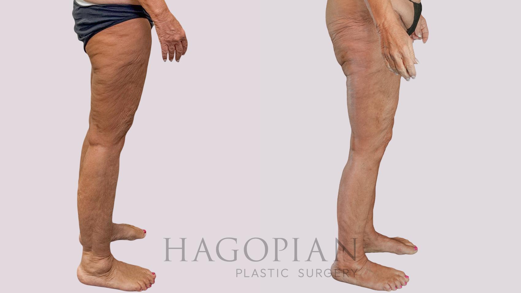 Before & After Thigh Lift Case 261 Right Side View in Atlanta, GA