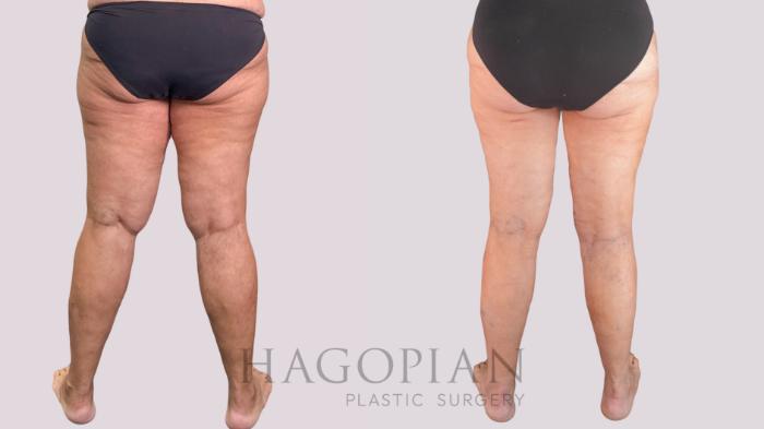 Before & After Thigh Lift Case 268 Back View in Atlanta, GA