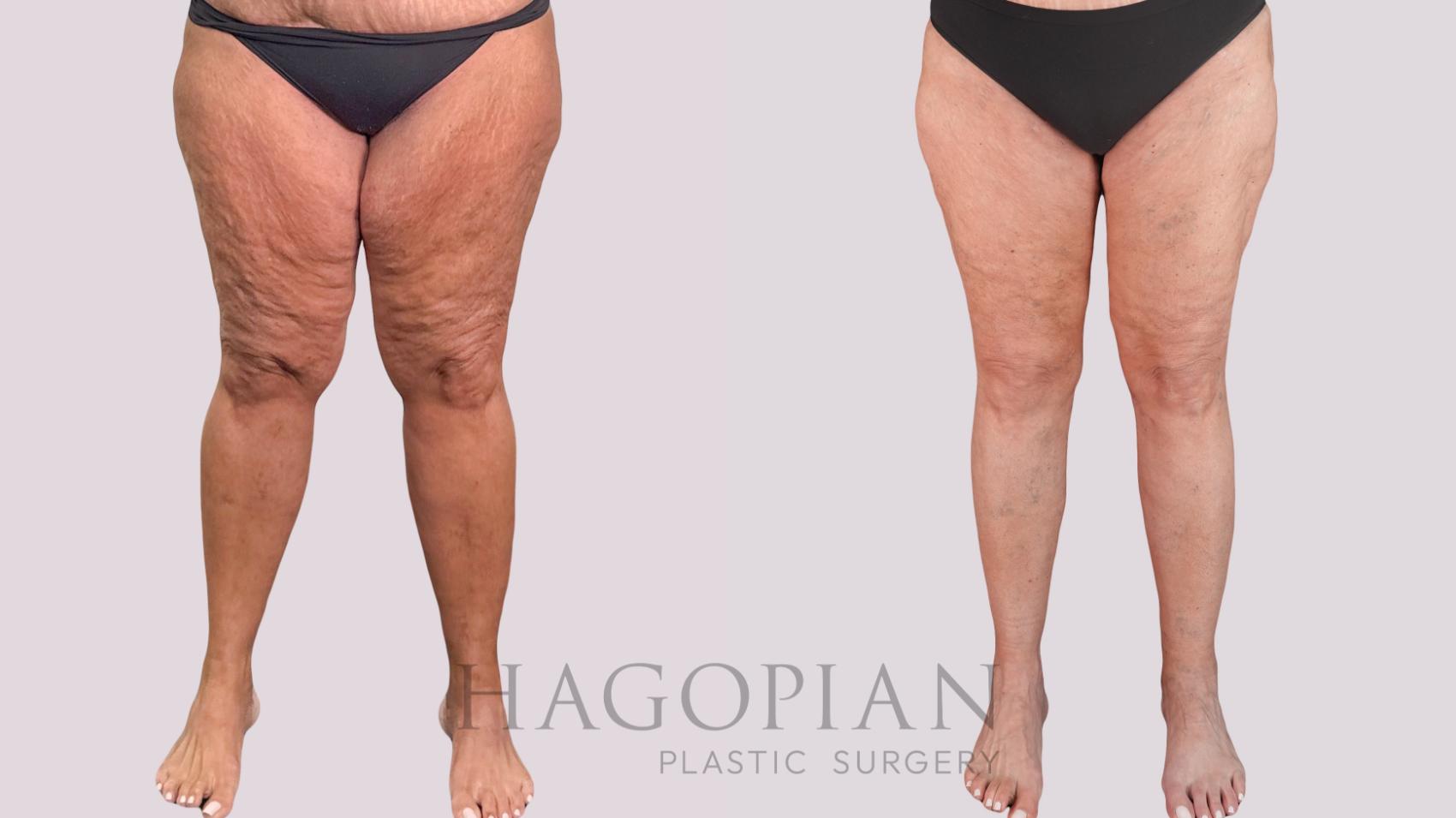 Before & After Thigh Lift Case 268 Front View in Atlanta, GA