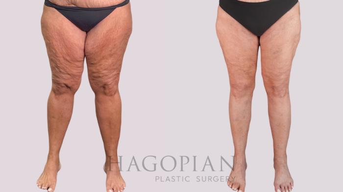 Before & After Thigh Lift Case 268 Front View in Atlanta, GA