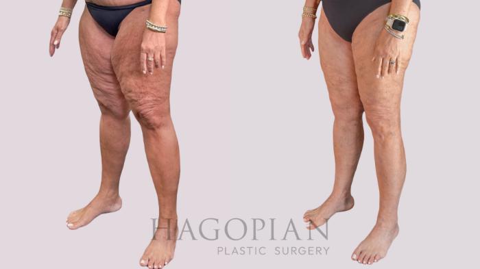 Before & After Thigh Lift Case 268 Left Oblique View in Atlanta, GA