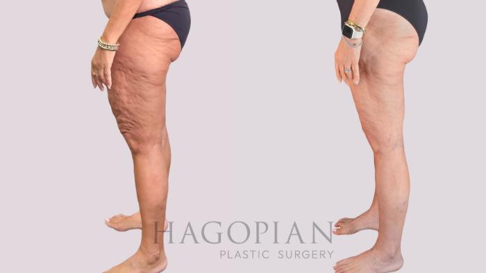 Before & After Thigh Lift Case 268 Left Side View in Atlanta, GA
