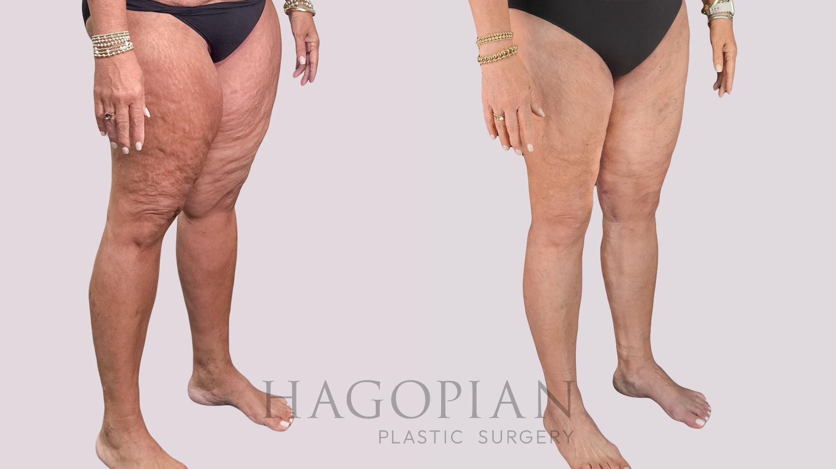 Before & After Thigh Lift Case 268 Right Oblique View in Atlanta, GA