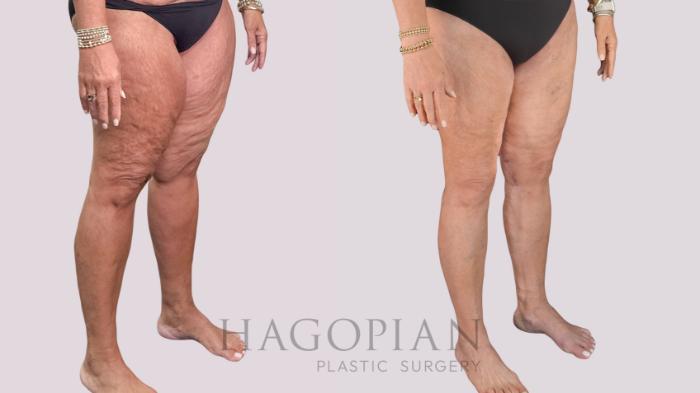 Before & After Thigh Lift Case 268 Right Oblique View in Atlanta, GA