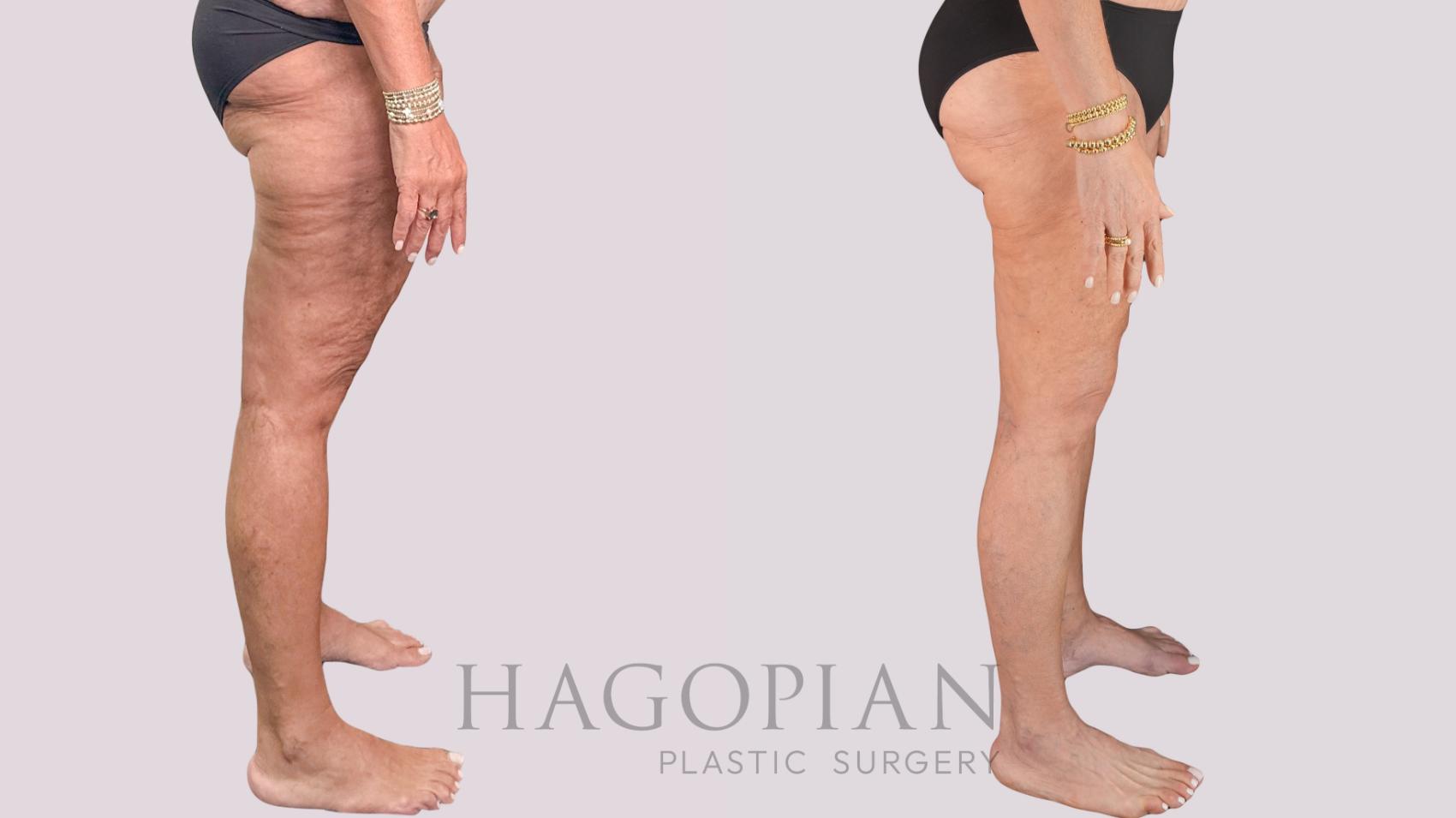 Before & After Thigh Lift Case 268 Right Side View in Atlanta, GA