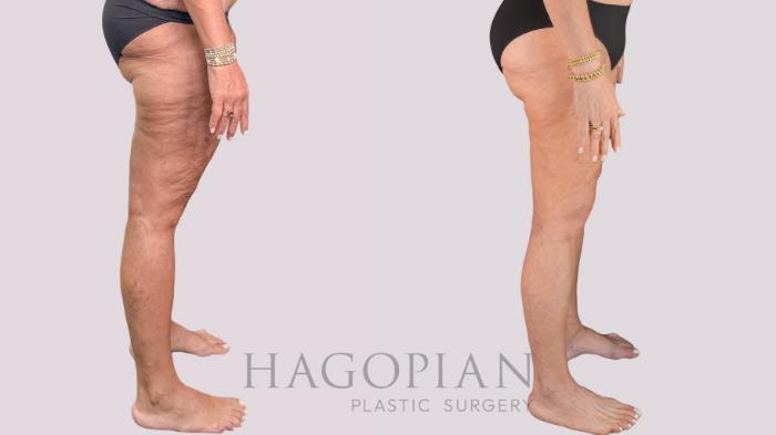 Before & After Thigh Lift Case 268 Right Side View in Atlanta, GA