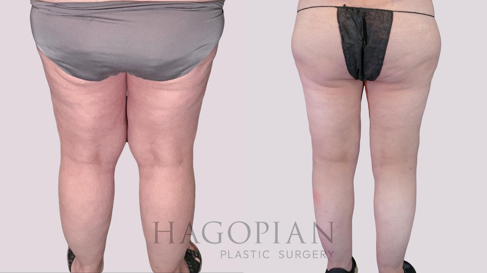 Before & After Thigh Lift Case 270 Back View in Atlanta, GA