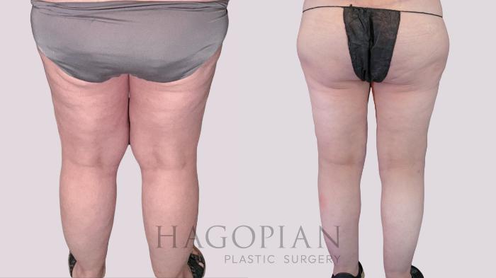 Before & After Thigh Lift Case 270 Back View in Atlanta, GA