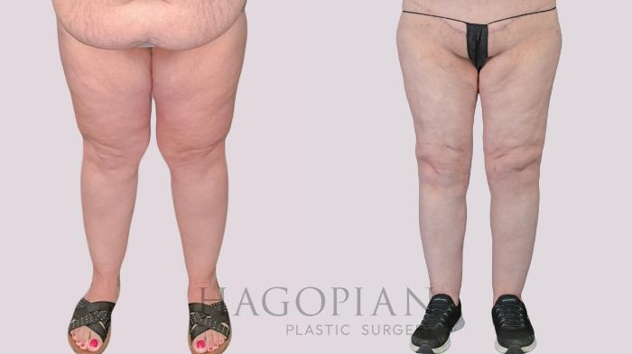 Before & After Thigh Lift Case 270 Front View in Atlanta, GA