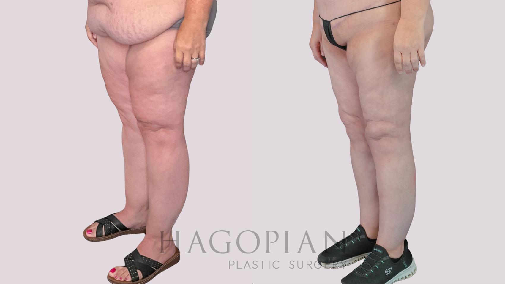 Before & After Thigh Lift Case 270 Left Oblique View in Atlanta, GA