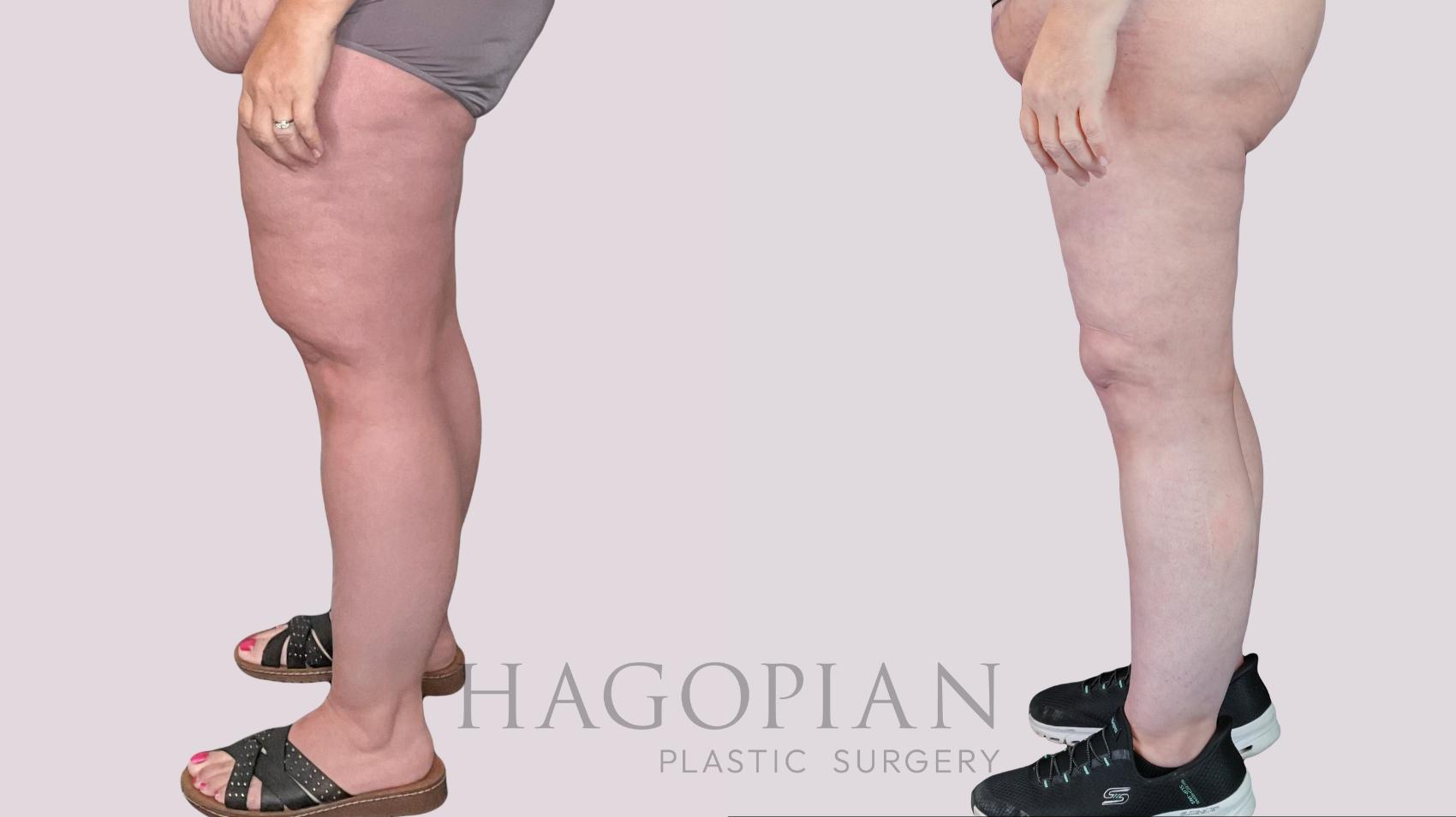 Before & After Thigh Lift Case 270 Left Side View in Atlanta, GA