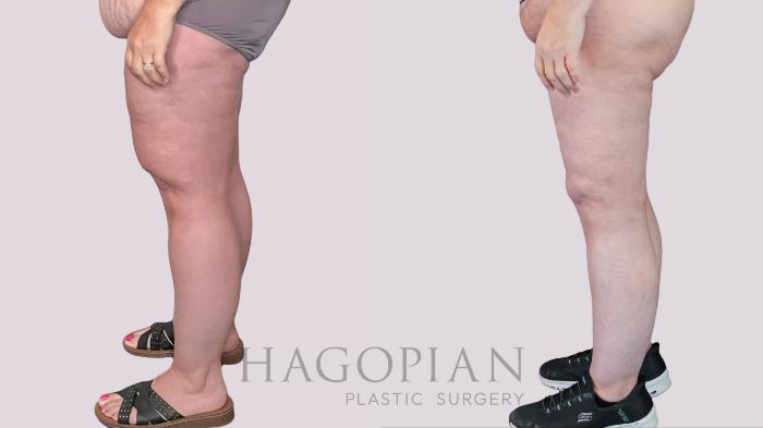 Before & After Thigh Lift Case 270 Left Side View in Atlanta, GA