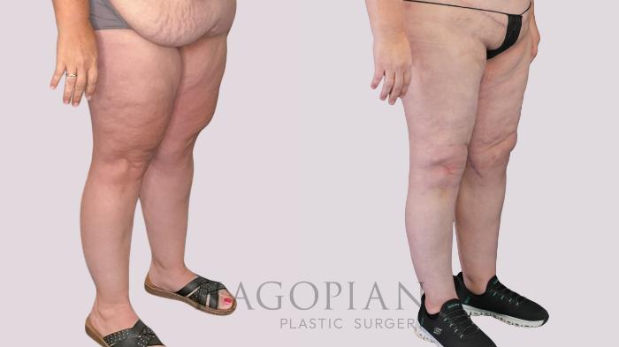 Before & After Thigh Lift Case 270 Right Oblique View in Atlanta, GA