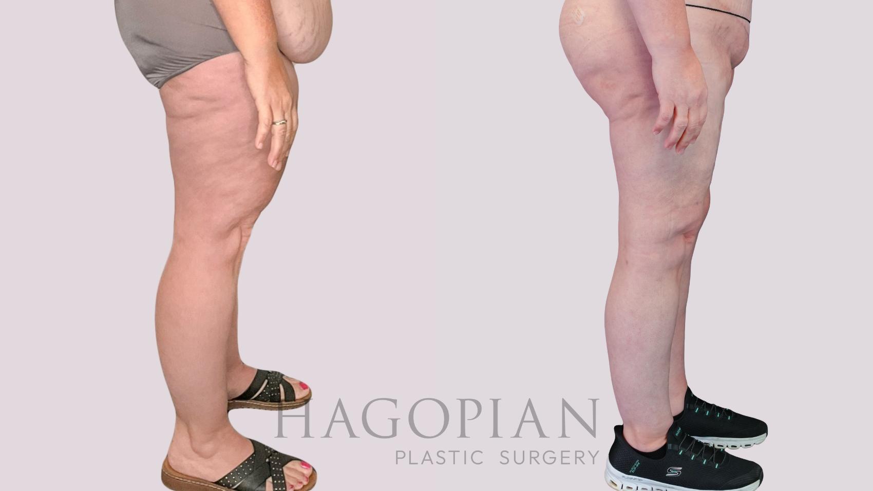 Before & After Thigh Lift Case 270 Right Side View in Atlanta, GA