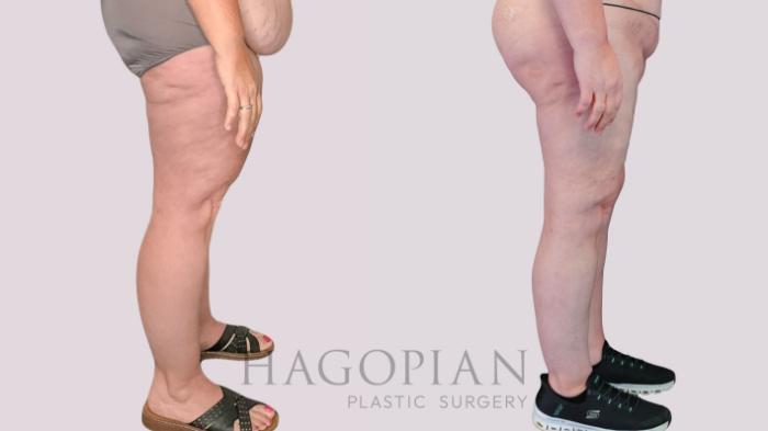 Before & After Thigh Lift Case 270 Right Side View in Atlanta, GA