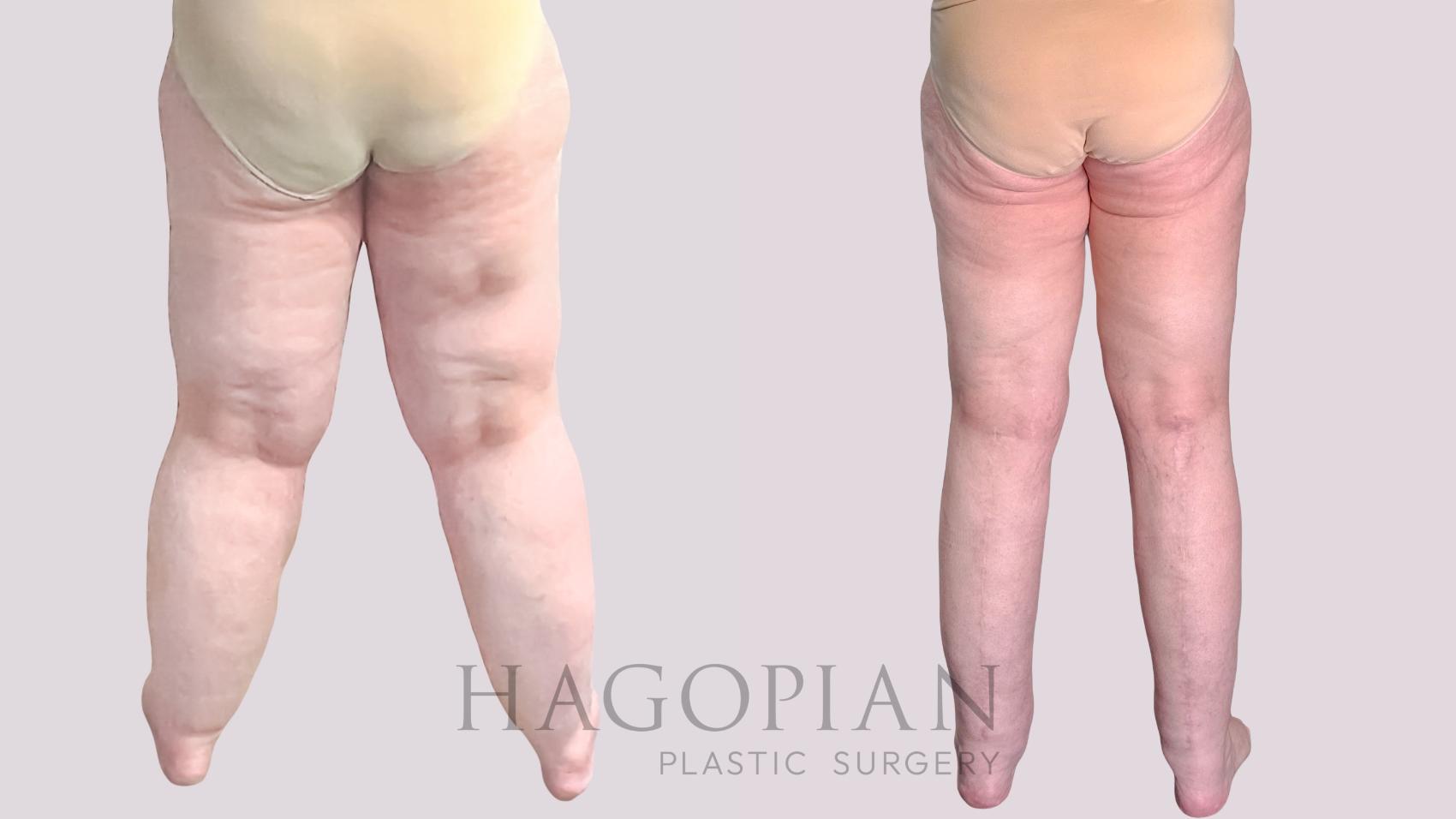 Before & After Thigh Lift Case 272 Back View in Atlanta, GA