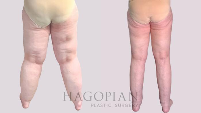 Before & After Thigh Lift Case 272 Back View in Atlanta, GA