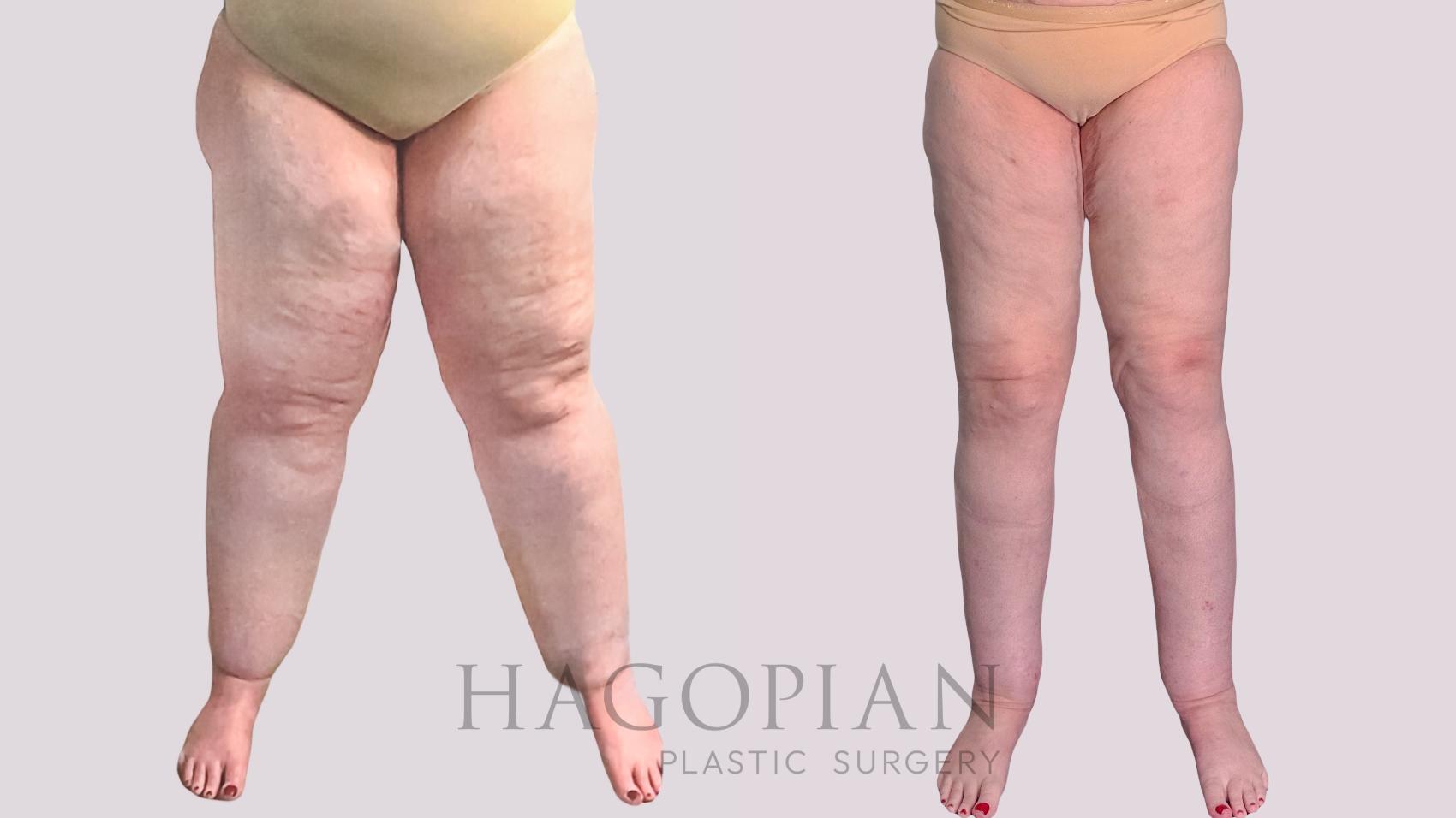 Before & After Thigh Lift Case 272 Left Side View in Atlanta, GA