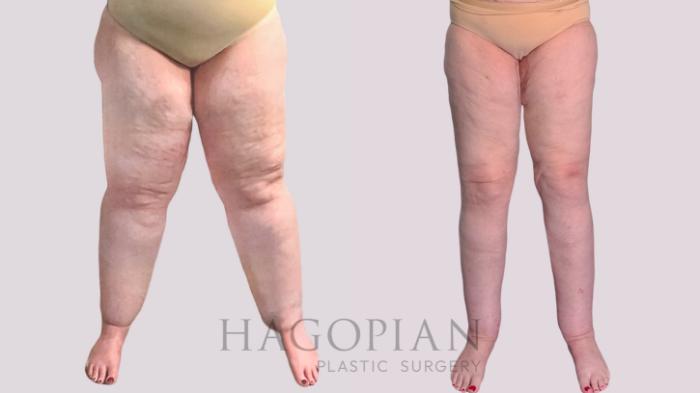 Before & After Thigh Lift Case 272 Left Side View in Atlanta, GA