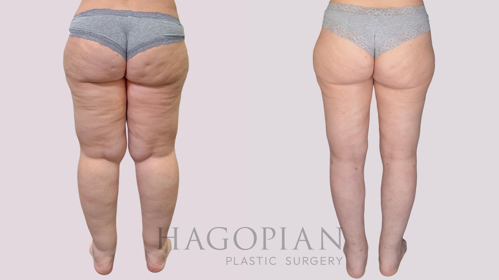 Before & After Thigh Lift Case 274 Back View in Atlanta, GA