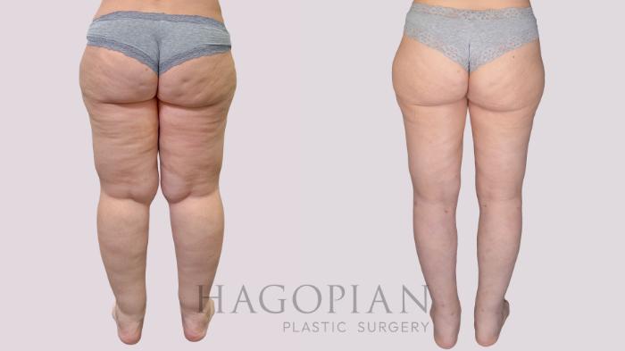 Before & After Thigh Lift Case 274 Back View in Atlanta, GA