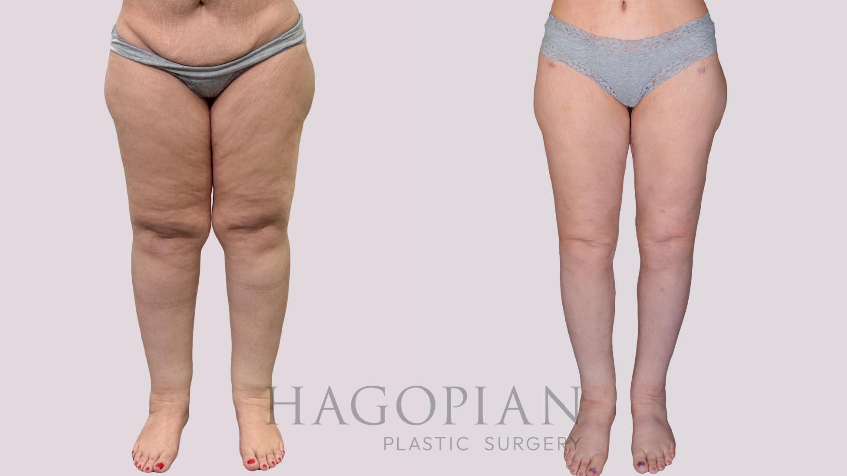 Before & After Thigh Lift Case 274 Front View in Atlanta, GA