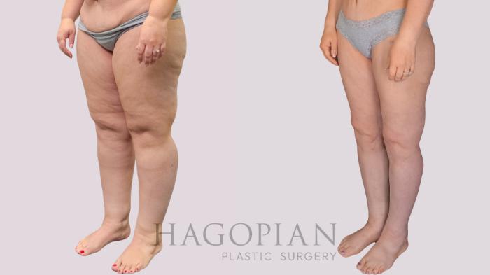 Before & After Thigh Lift Case 274 Left Oblique View in Atlanta, GA