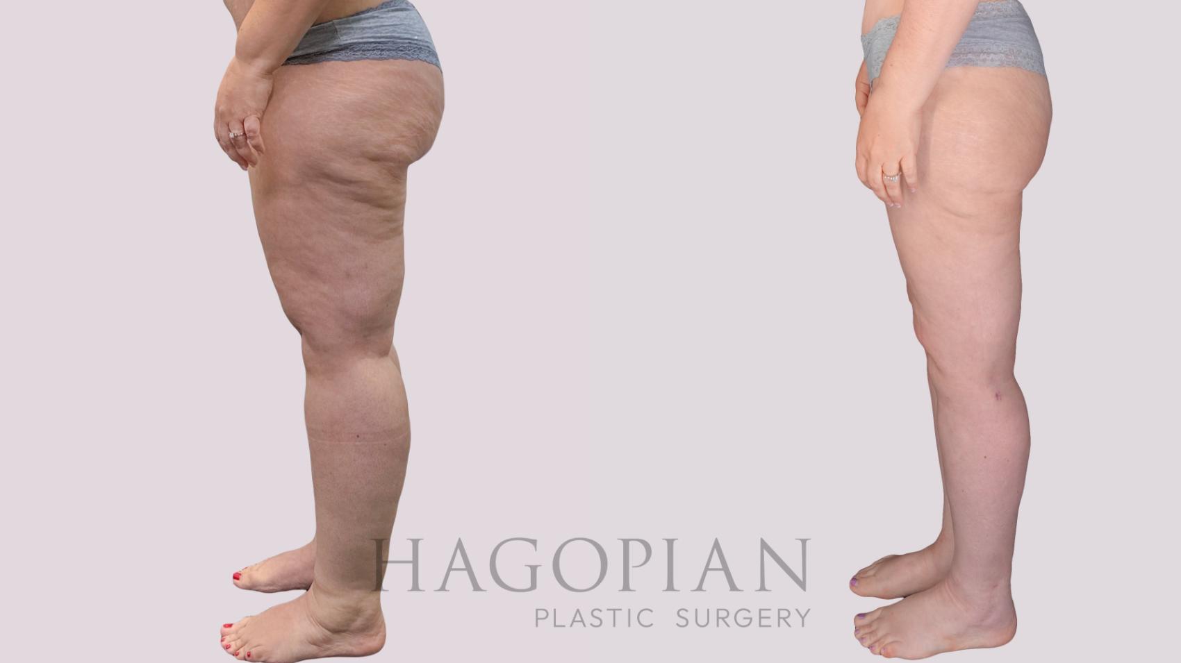 Before & After Thigh Lift Case 274 Left Side View in Atlanta, GA