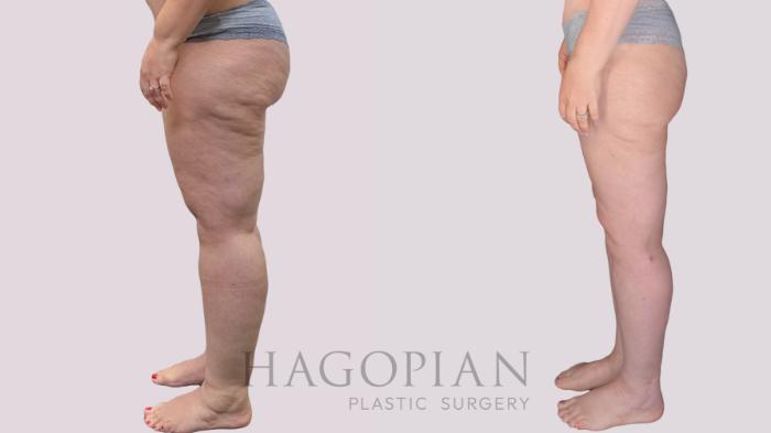 Before & After Thigh Lift Case 274 Left Side View in Atlanta, GA