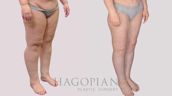 Before & After Thigh Lift Case 274 Right Oblique View in Atlanta, GA