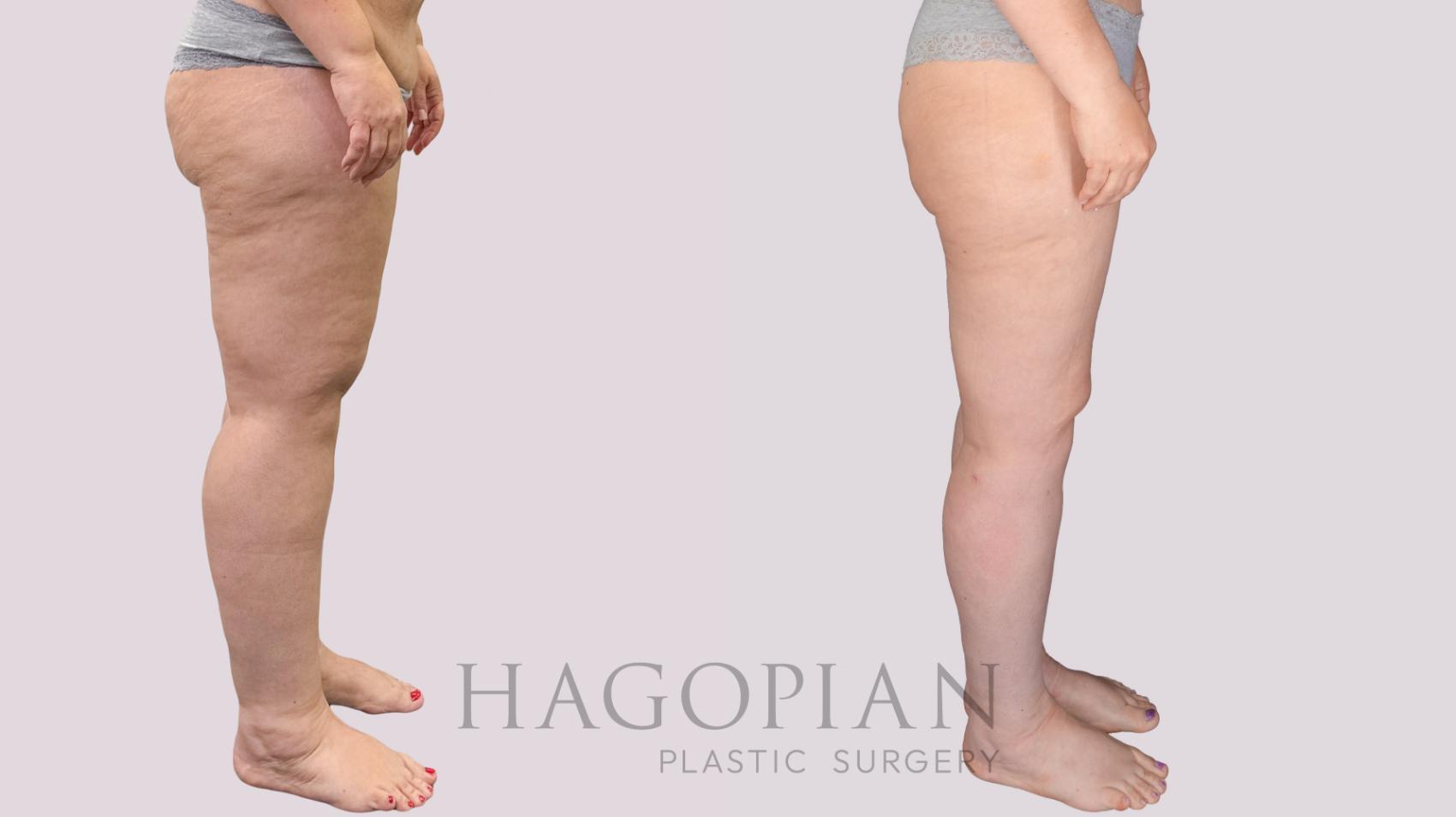 Before & After Thigh Lift Case 274 Right Side View in Atlanta, GA