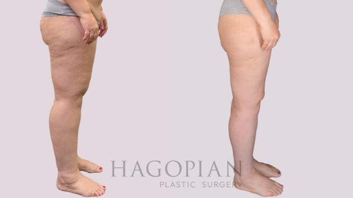 Before & After Thigh Lift Case 274 Right Side View in Atlanta, GA
