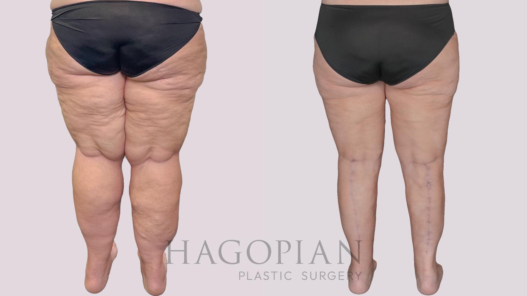 Before & After Thigh Lift Case 278 Back View in Atlanta, GA