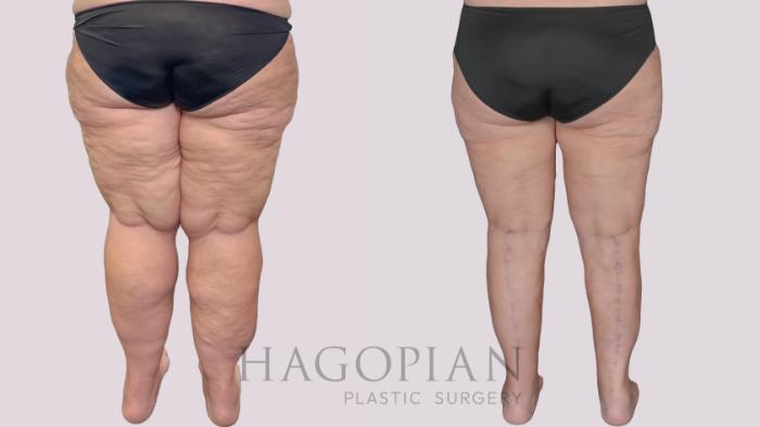 Before & After Thigh Lift Case 278 Back View in Atlanta, GA