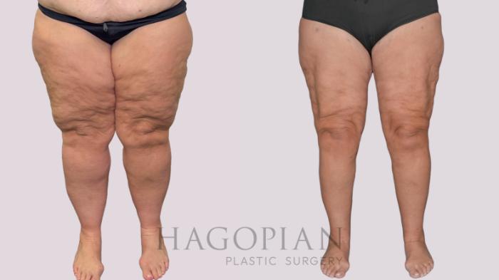 Before & After Thigh Lift Case 278 Front View in Atlanta, GA