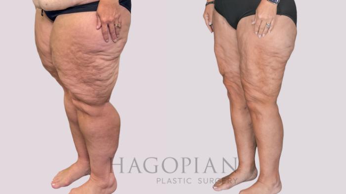 Before & After Thigh Lift Case 278 Left Oblique View in Atlanta, GA