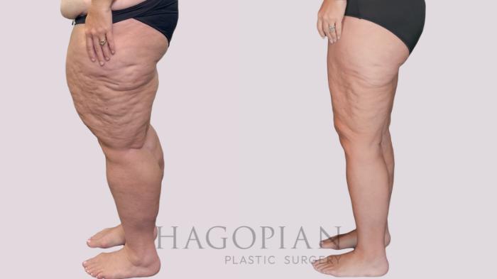 Before & After Thigh Lift Case 278 Left Side View in Atlanta, GA