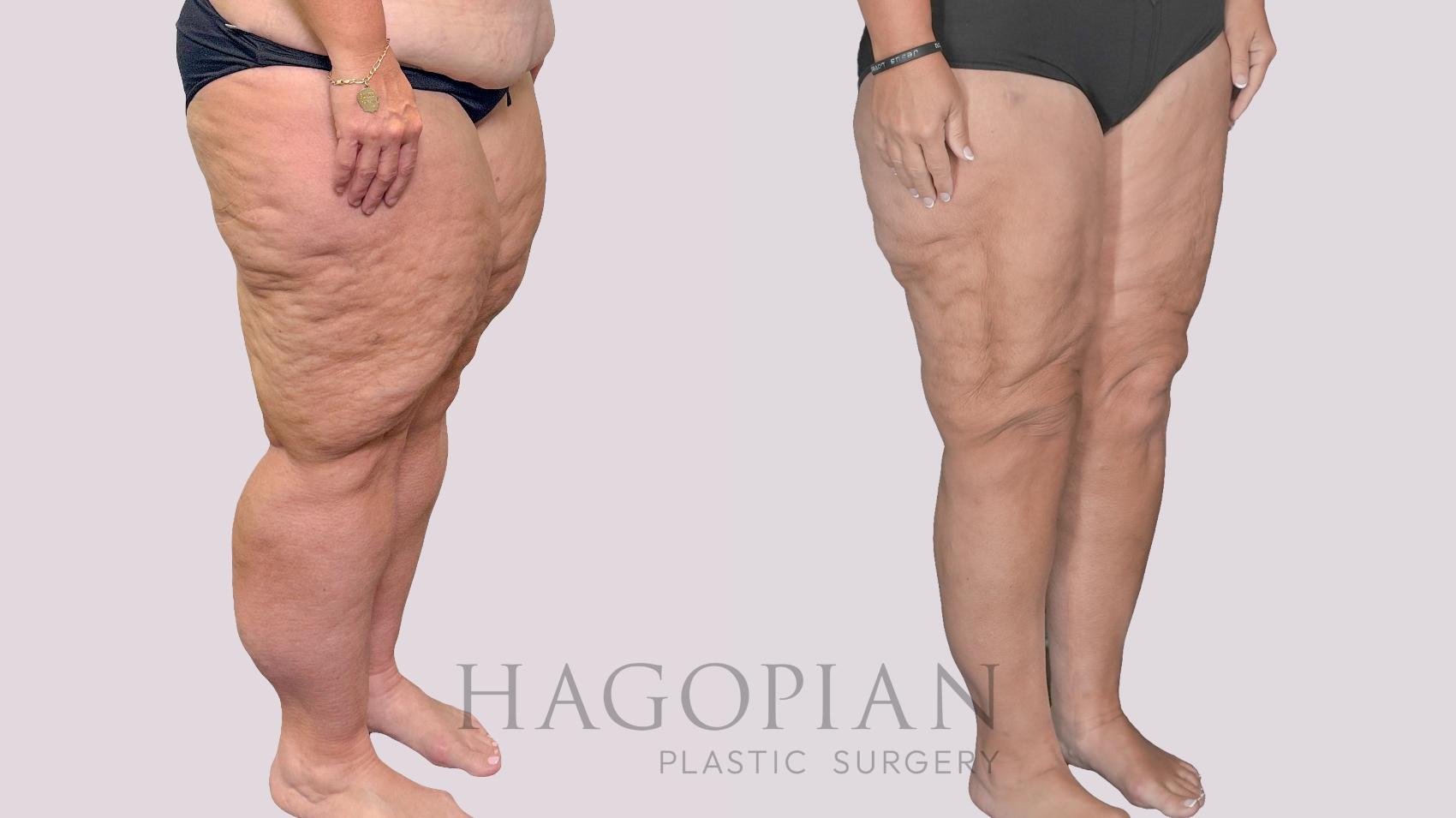 Before & After Thigh Lift Case 278 Right Oblique View in Atlanta, GA