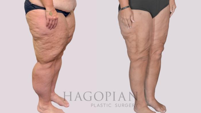 Before & After Thigh Lift Case 278 Right Oblique View in Atlanta, GA