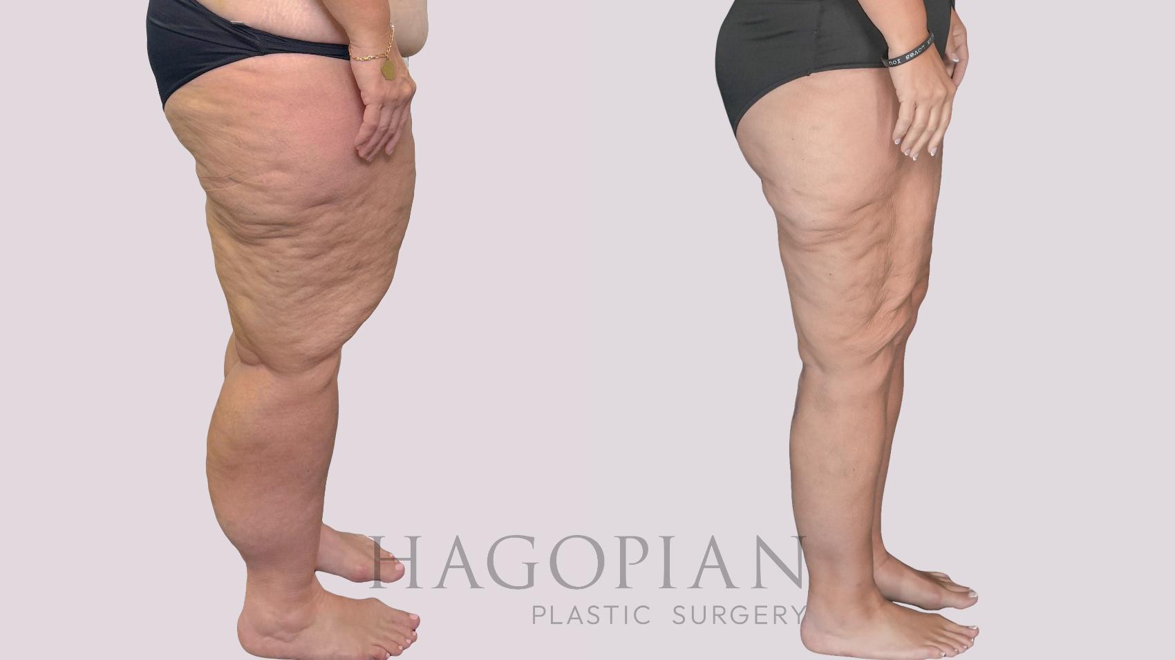 Before & After Thigh Lift Case 278 Right Side View in Atlanta, GA