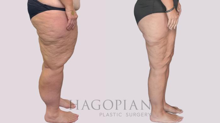 Before & After Thigh Lift Case 278 Right Side View in Atlanta, GA
