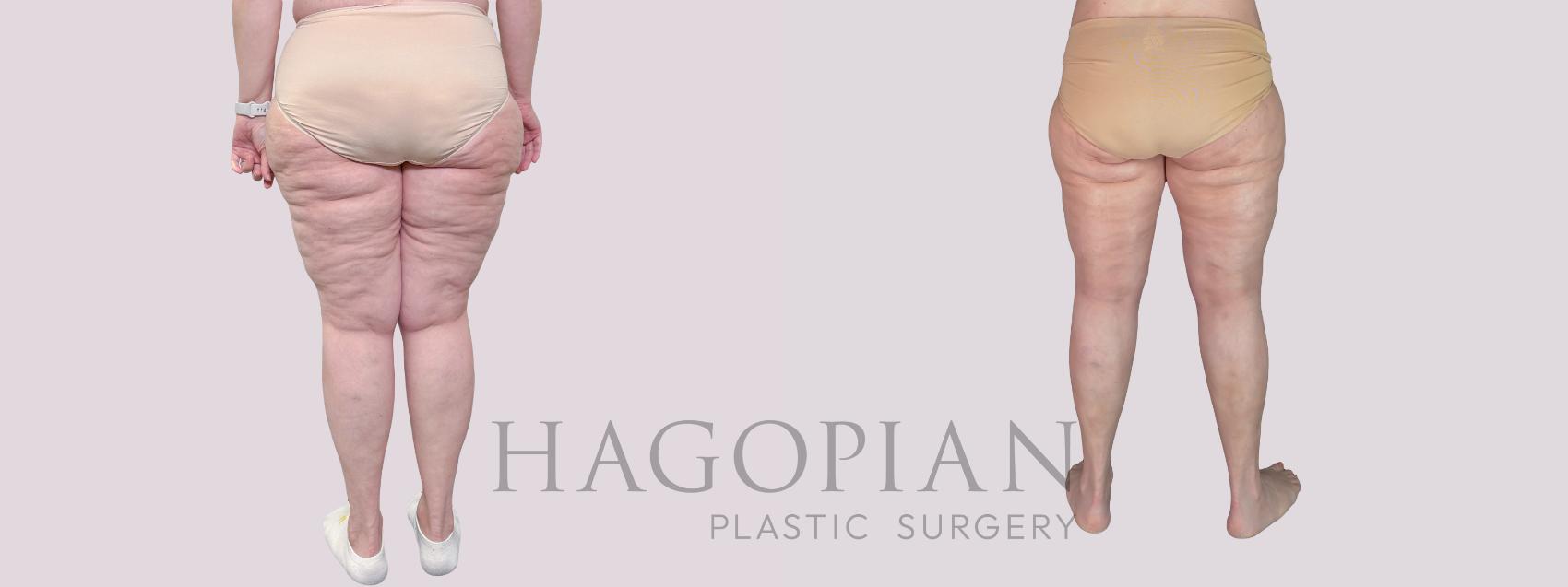 Before & After Thigh Lift Case 281 Back View in Atlanta, GA