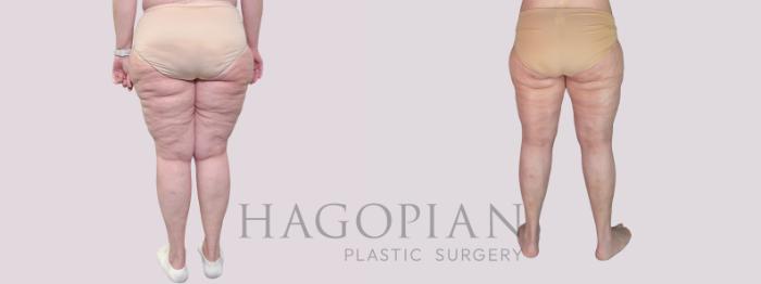 Before & After Thigh Lift Case 281 Back View in Atlanta, GA