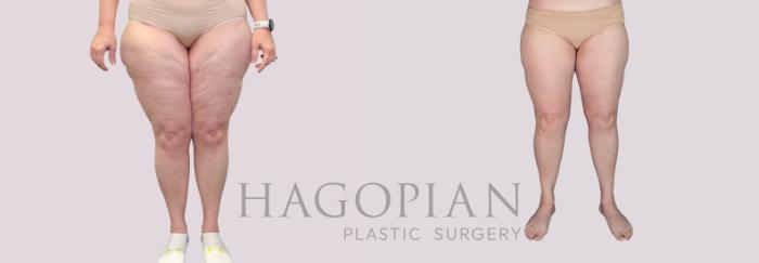 Before & After Thigh Lift Case 281 Front View in Atlanta, GA