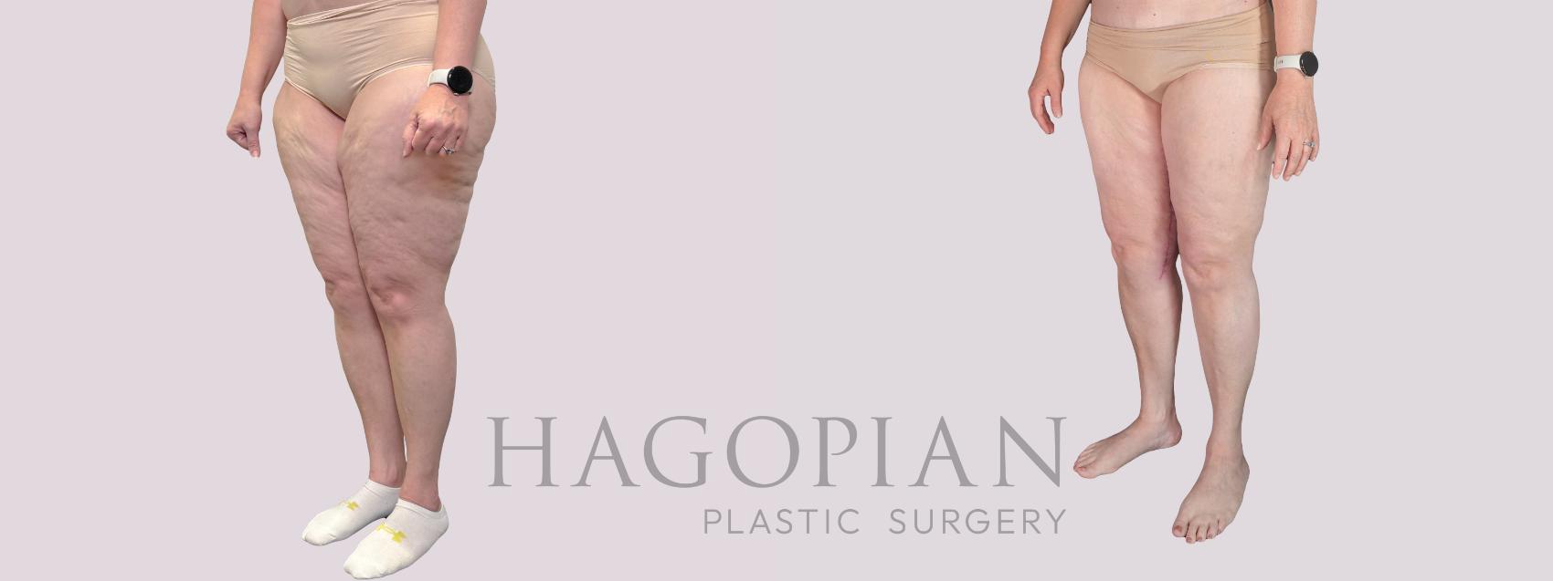 Before & After Thigh Lift Case 281 Left Oblique View in Atlanta, GA