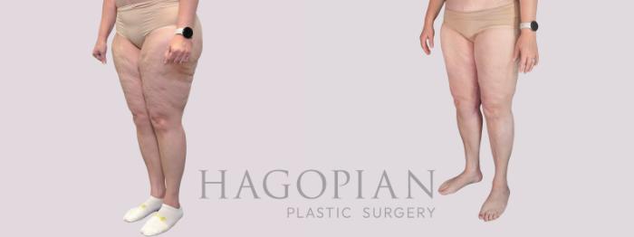 Before & After Thigh Lift Case 281 Left Oblique View in Atlanta, GA
