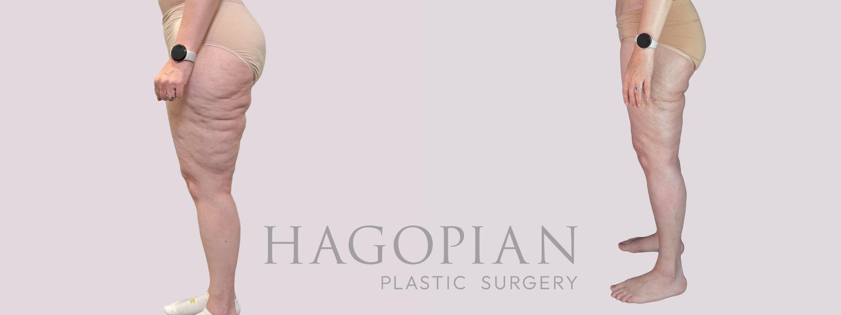 Before & After Thigh Lift Case 281 Left Side View in Atlanta, GA