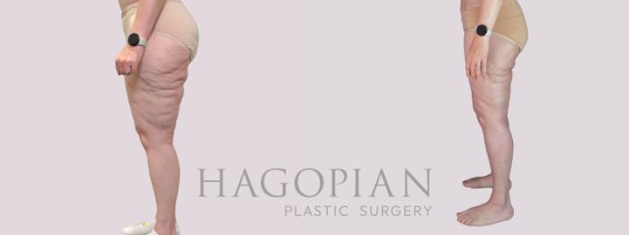 Before & After Thigh Lift Case 281 Left Side View in Atlanta, GA