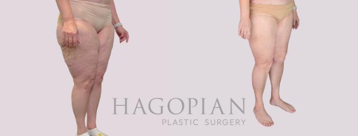 Before & After Thigh Lift Case 281 Right Oblique View in Atlanta, GA